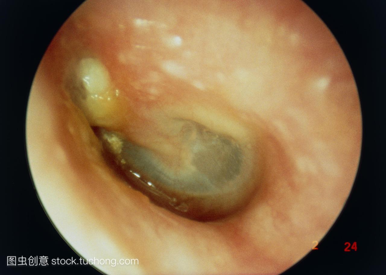 胆脂瘤通过穿孔鼓膜可见。沿外耳道可见巨大的