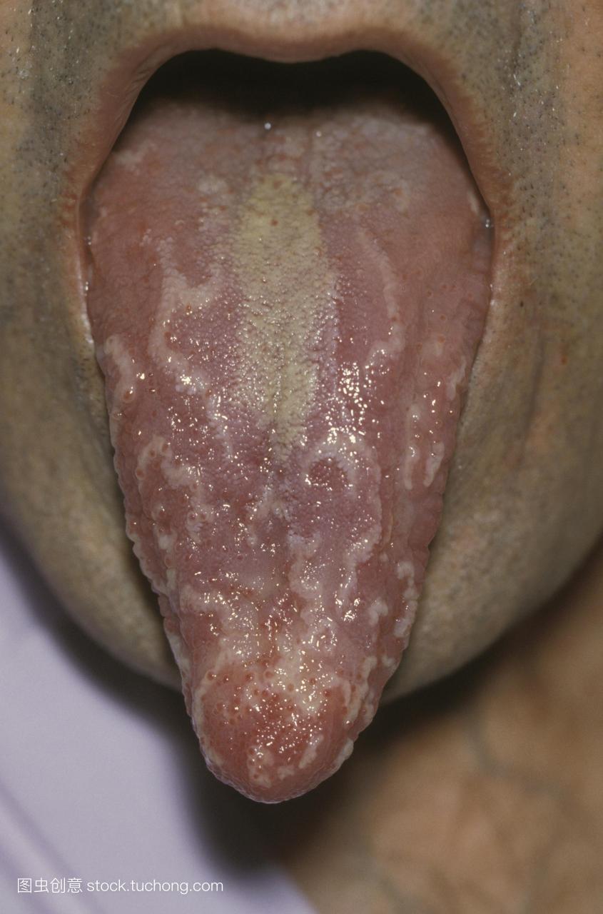 地理的舌头吐舌头的男性病人显示与maplike表