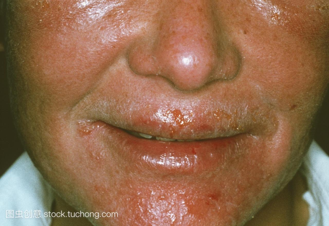 急性湿疹。皮肤瘙痒红斑并在患急性湿疹的病人