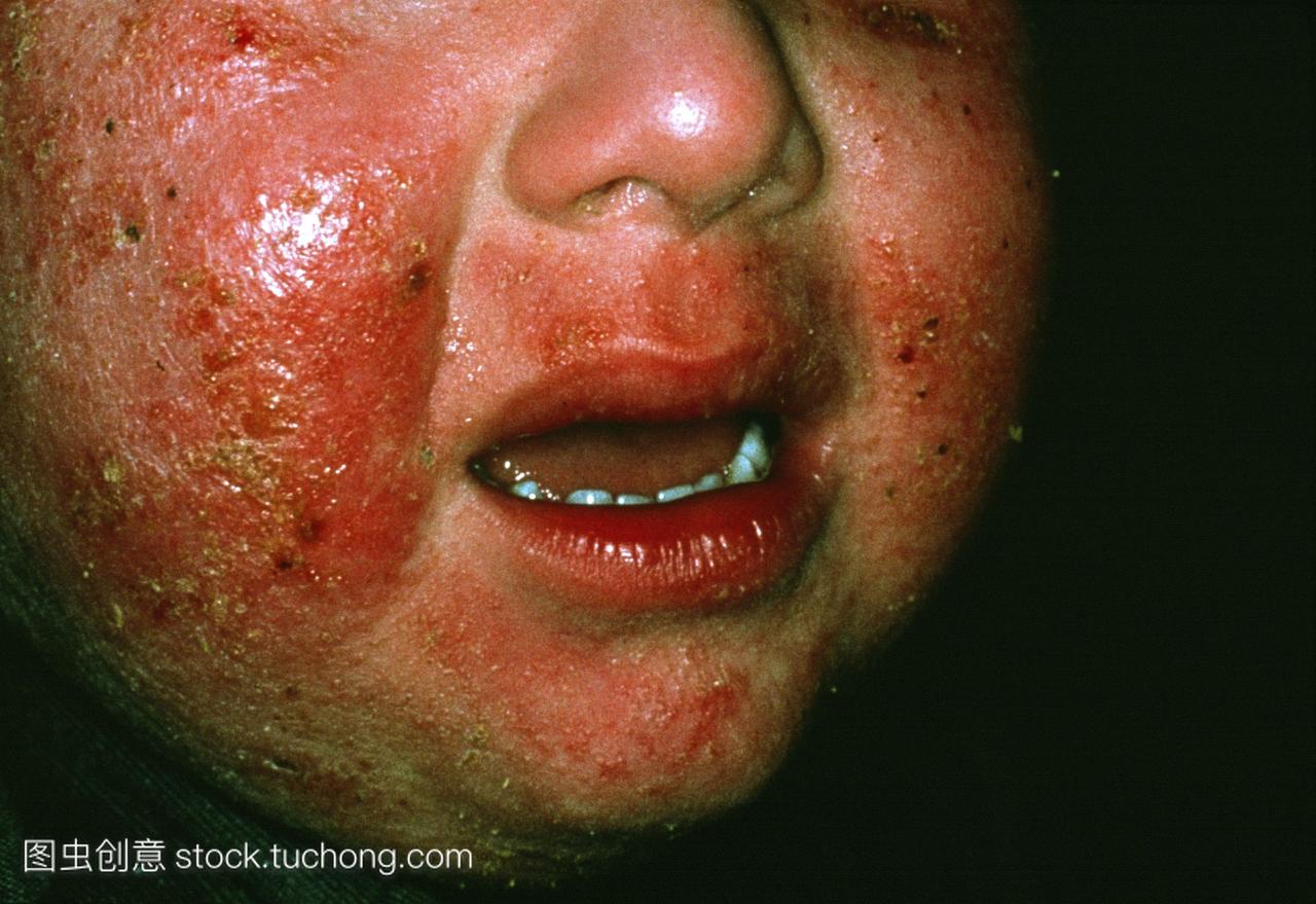 特应性湿疹在孩子的脸上。皮肤红色鳞片状和发
