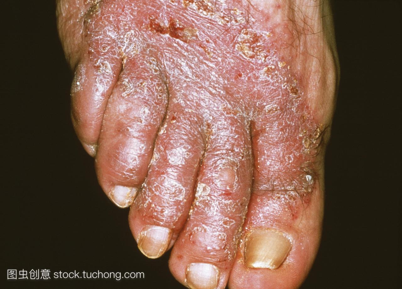 湿疹和真菌感染病人的脚。湿疹是皮肤的炎症,