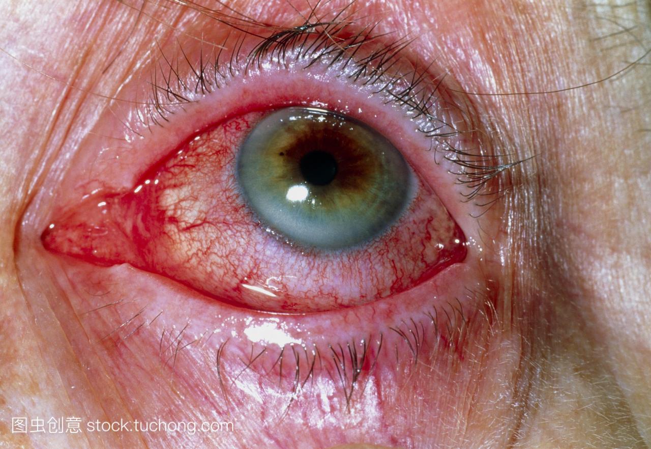 过敏性结膜炎的眼睛59年的老太太。的红色是