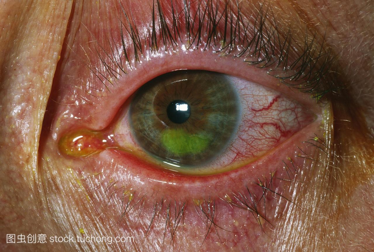 45岁的女人的眼睛角膜磨损。磨损了可见使用