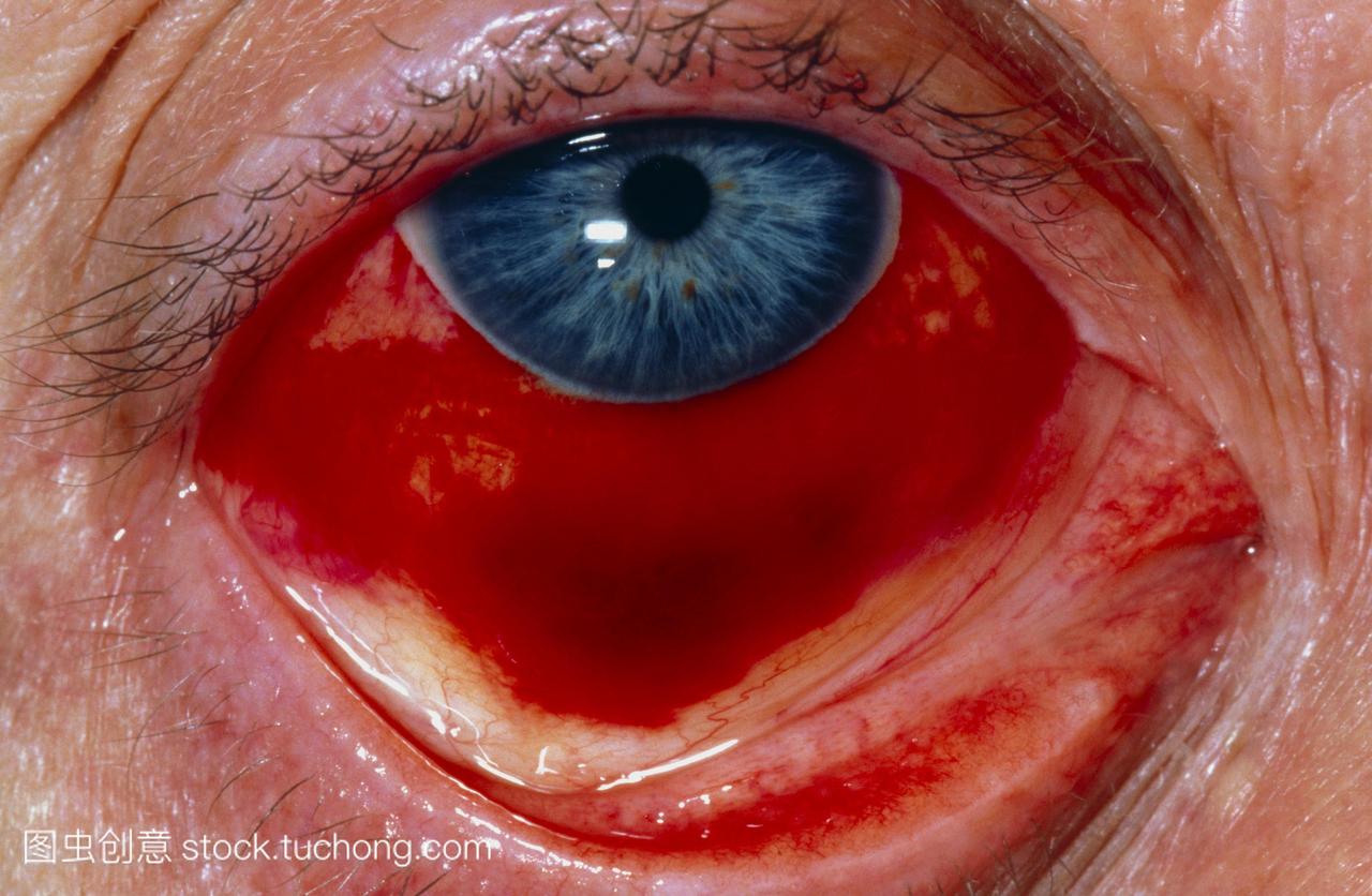 眼睛的特写显示结膜出血。血管破裂后的血液从