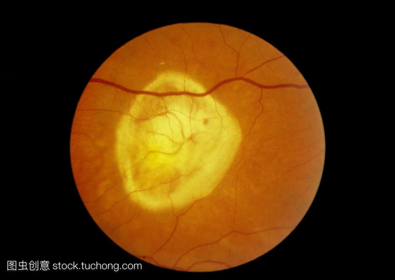 视网膜变性。眼镜观察病人眼睛的视网膜,显示