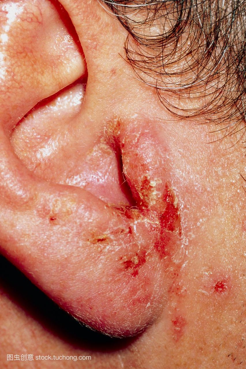 耳朵感染。在成年男性的耳膜外耳炎的特写。外