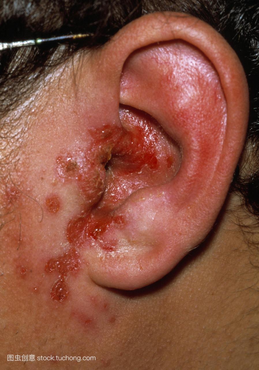 外耳感染。一名20岁男子患中耳炎,在游泳池中