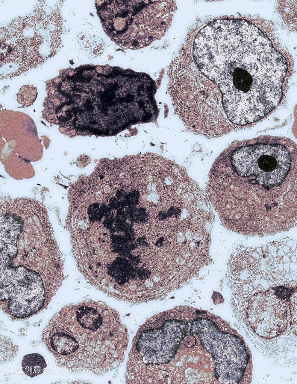 浆细胞瘤。彩色透射电子显微镜TEM的恶性细
