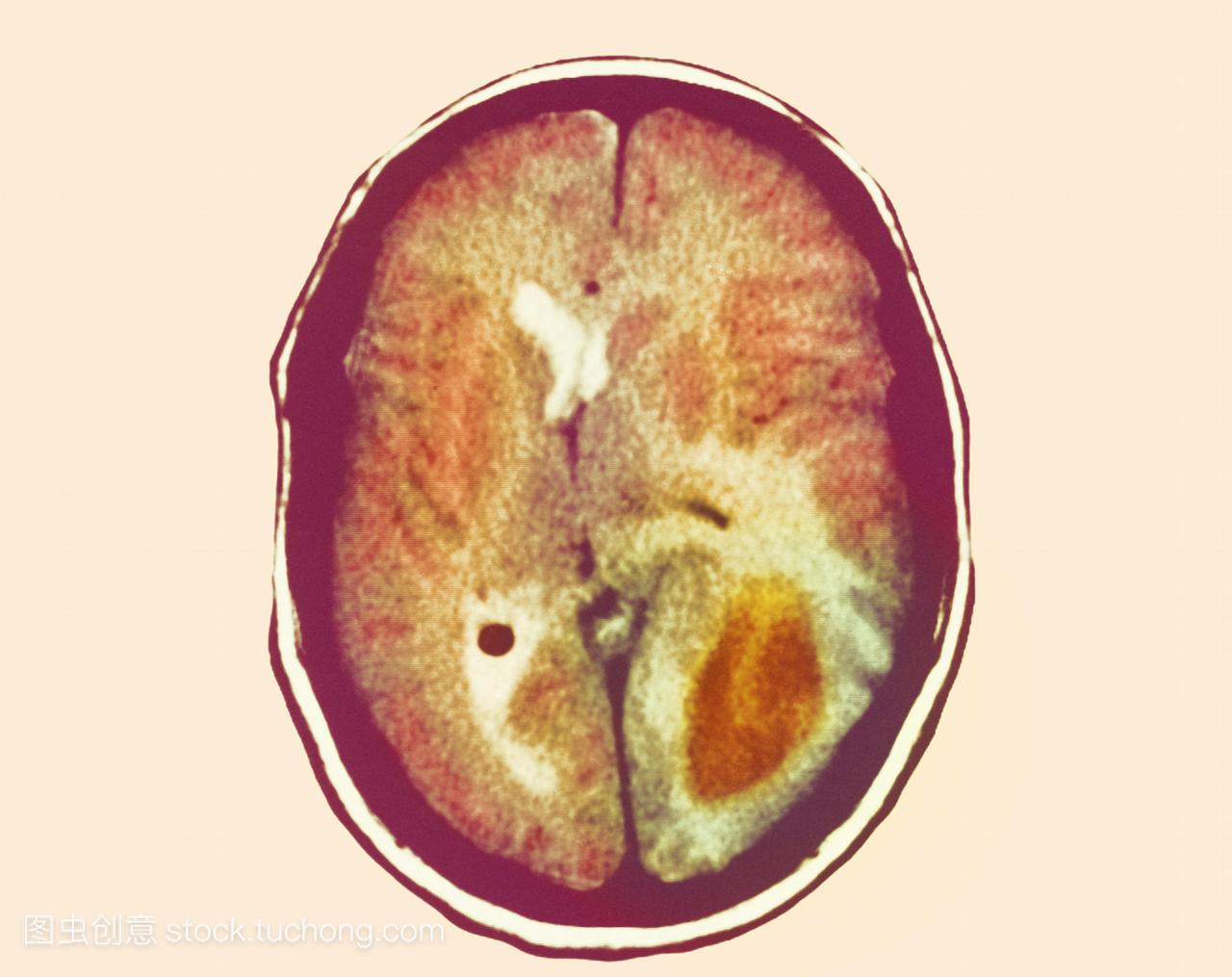 神经胶质瘤脑癌图片1的2的计算机断层扫描ct扫