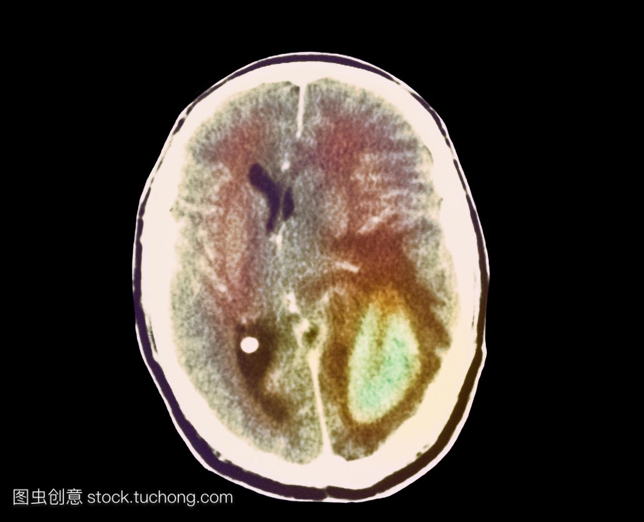 脑癌的增长。图片2的2的计算机断层扫描CT扫