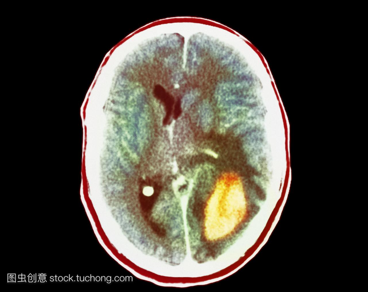神经胶质瘤脑癌。图12彩色计算机断层扫描ct在