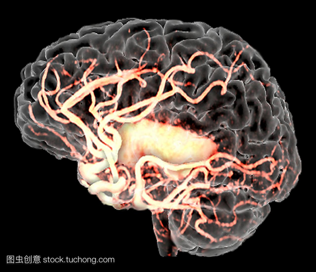 卒中后的大脑,或脑血管意外cva。主要的动脉是