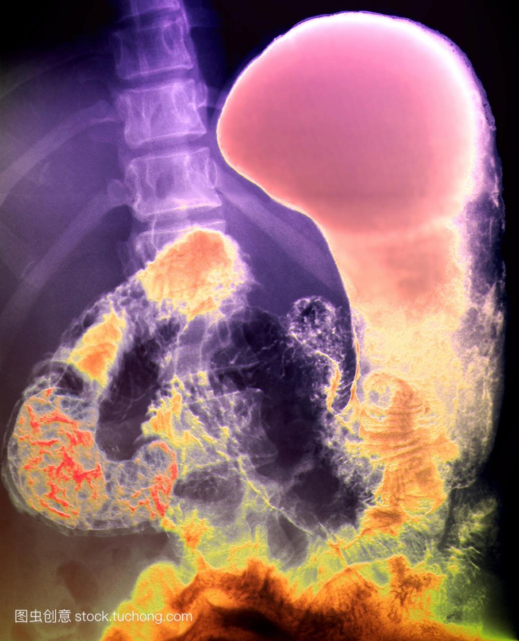 肠道疾病。彩色的x射线的27岁的十二指肠憩室