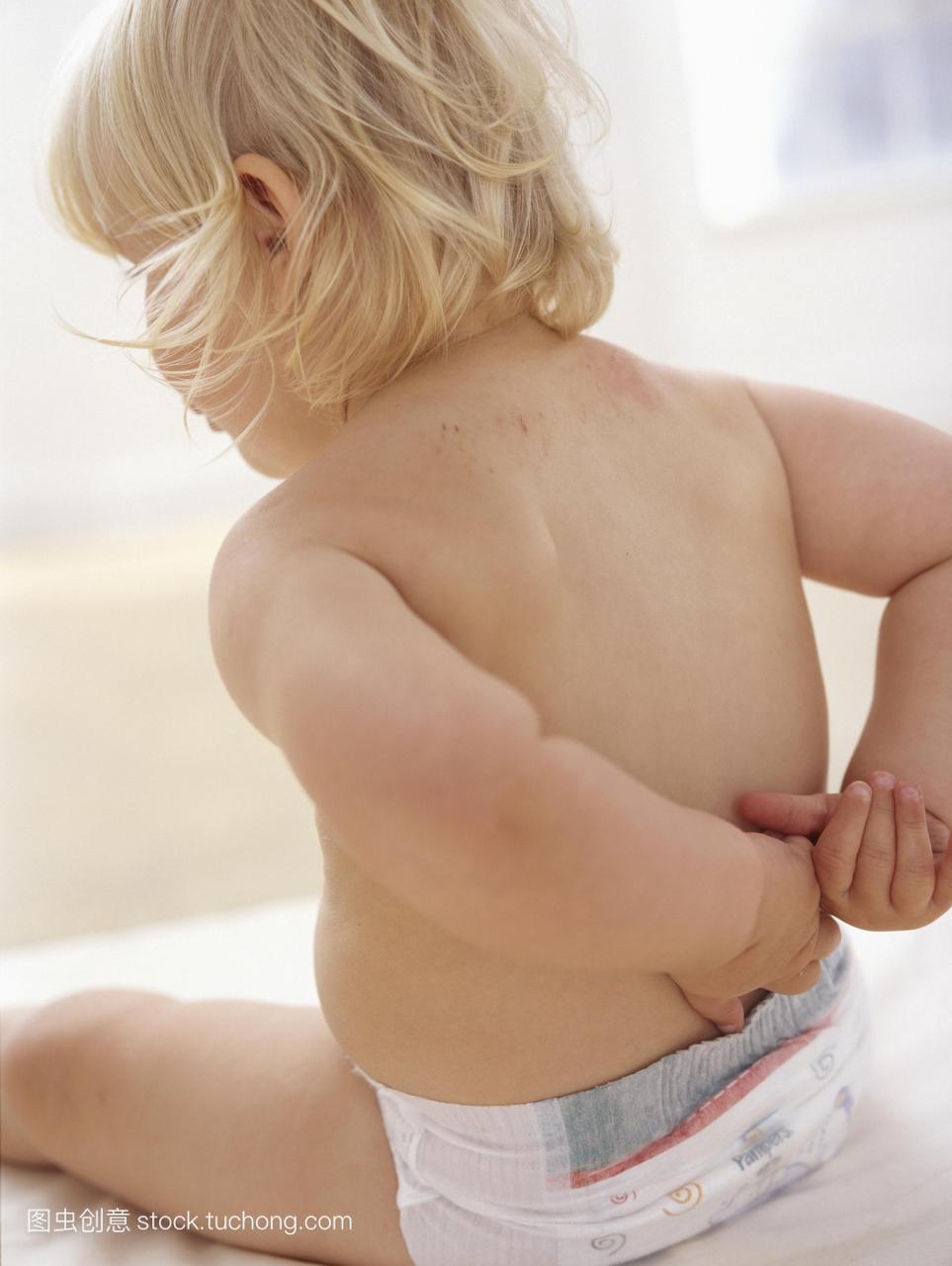 一个16个月大的女婴的后背上出现了湿疹。皮