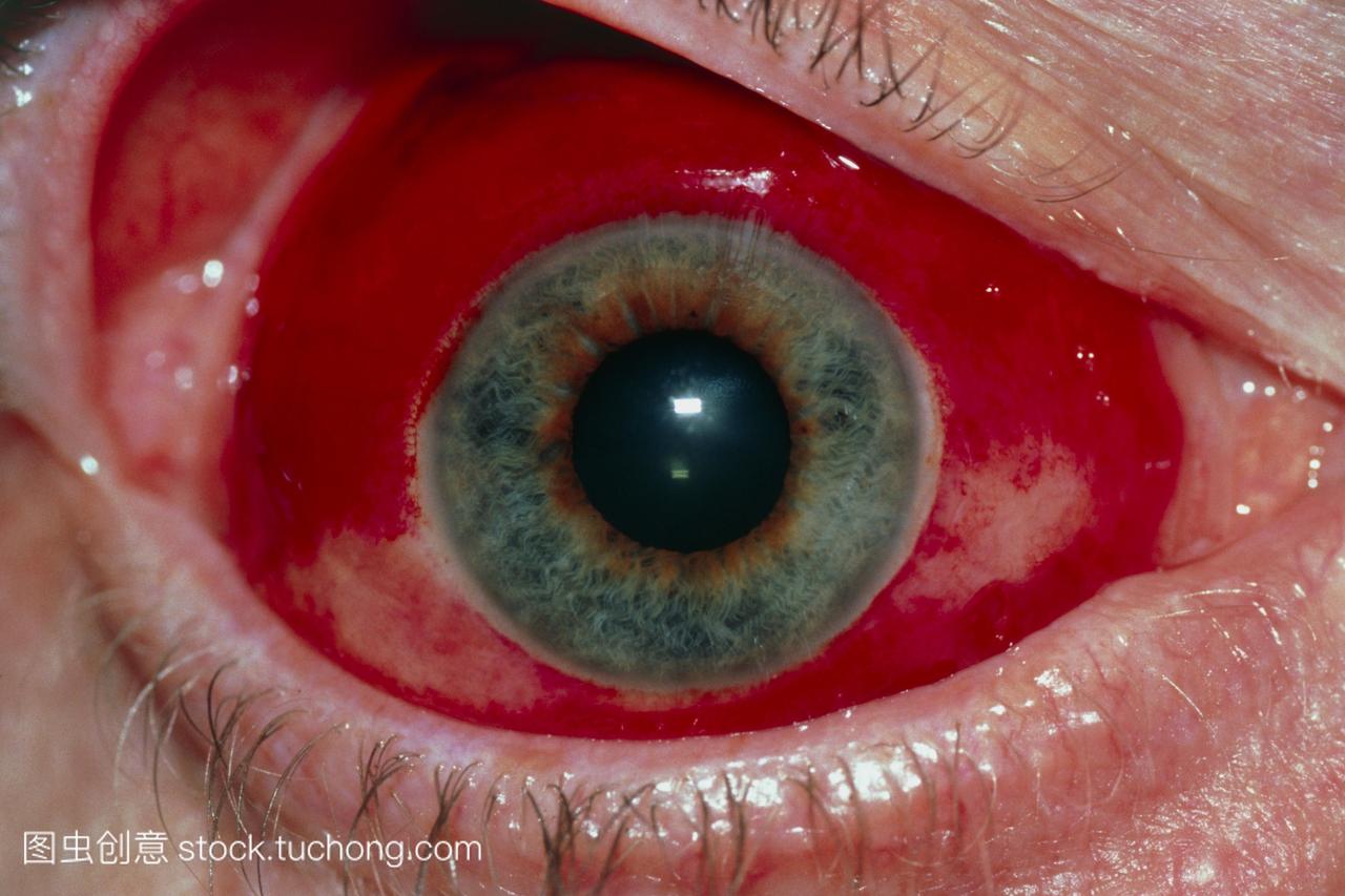sub-conjunctival出血。近视眼显示自发出血,称
