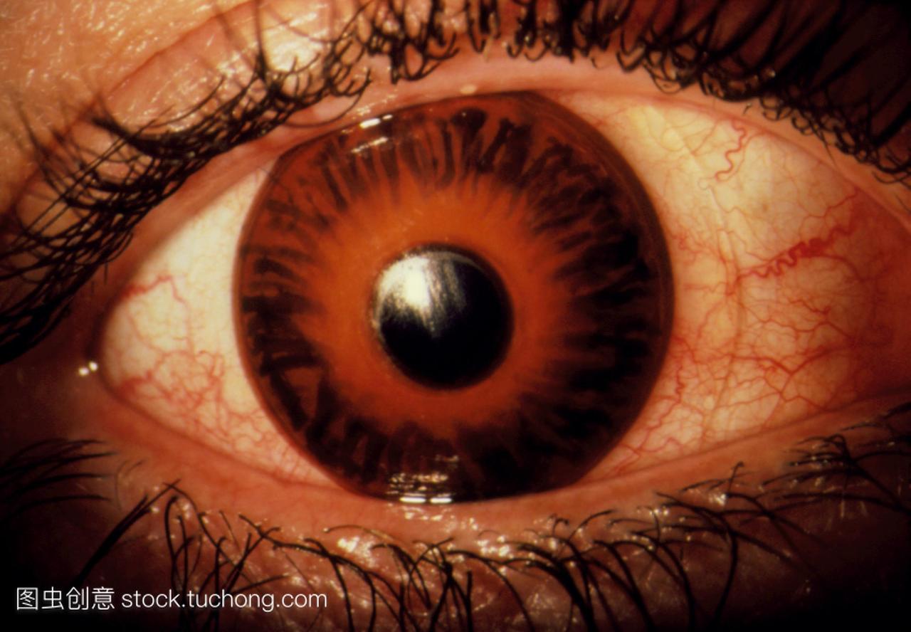 青光眼特写痛红肿的眼睛被一个隐形眼镜。青光