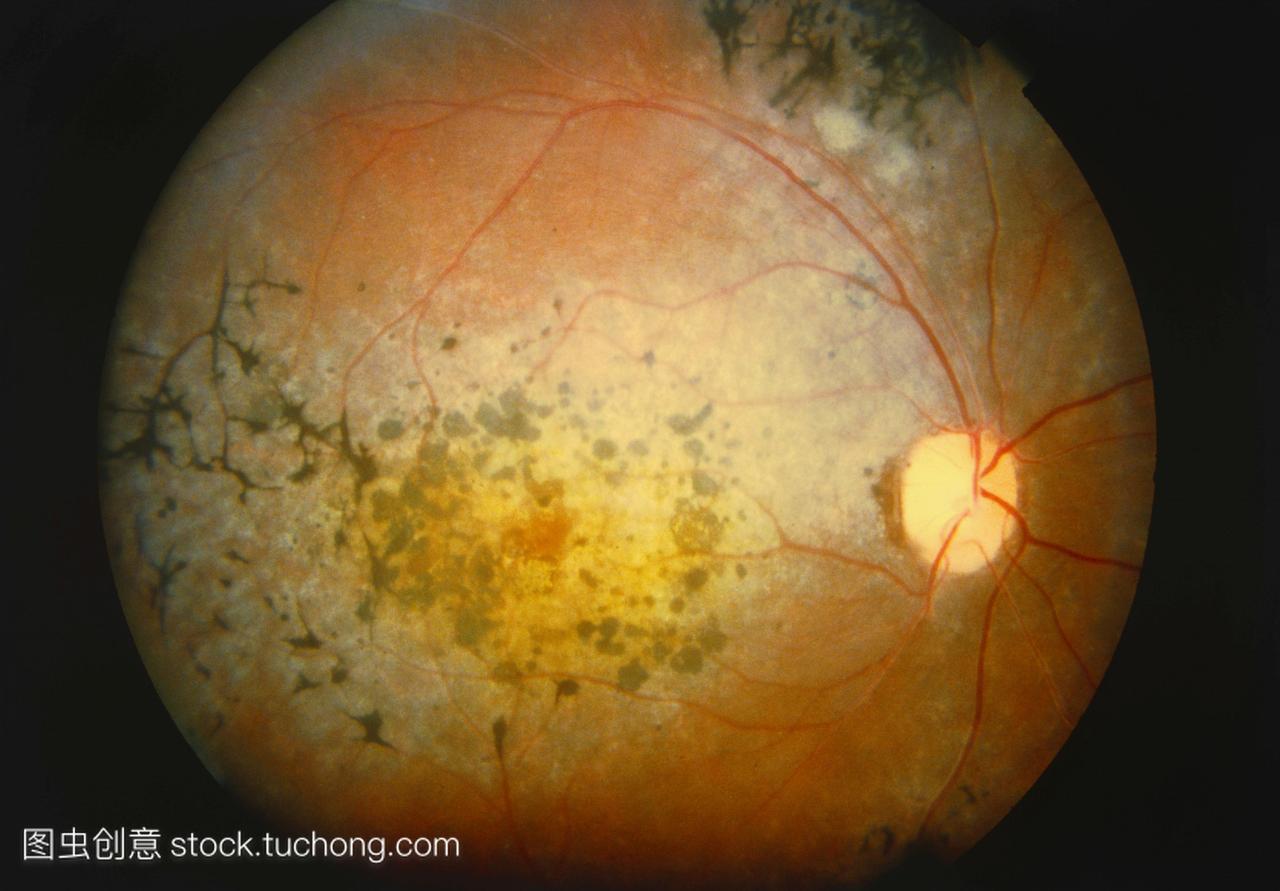 色素性视网膜炎眼底相机图像显示视网膜变性的