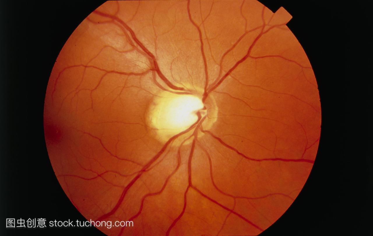 圆形区域的增大。青光眼通常意味着眼压升高。
