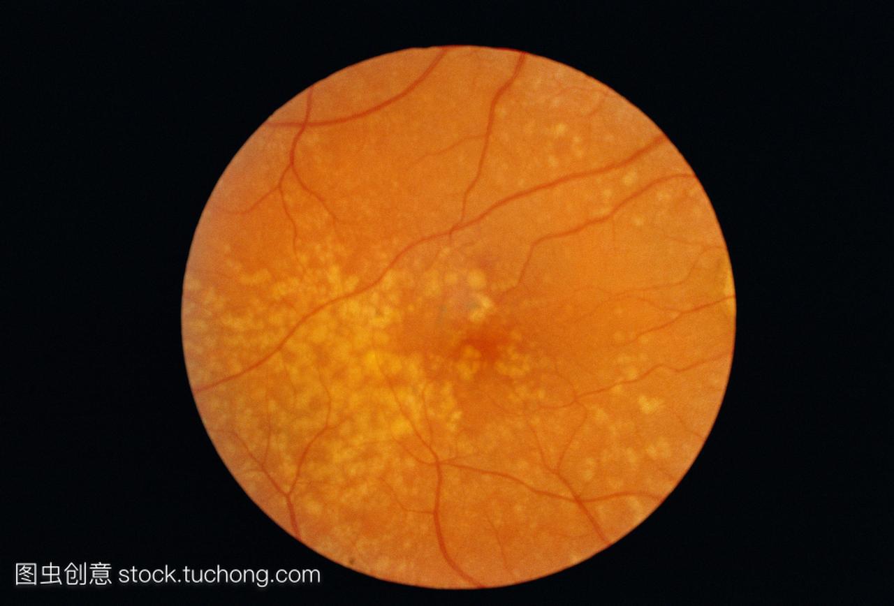 黄斑变性检眼镜的形象。视网膜上可见大量的黄