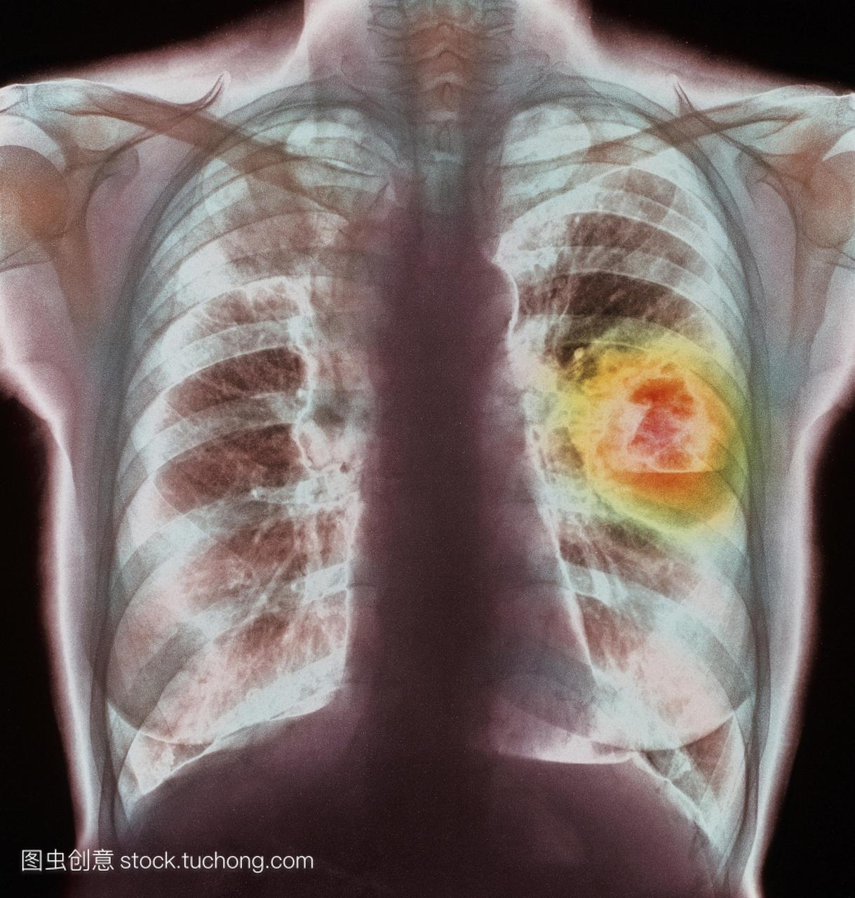 肺癌。彩色的胸部x光片显示肺癌在正面视图中