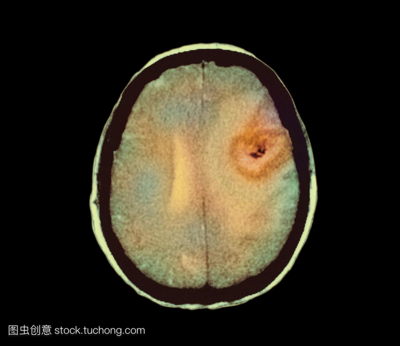 脑癌的增长。2彩色电脑断层扫描ct在一个49岁