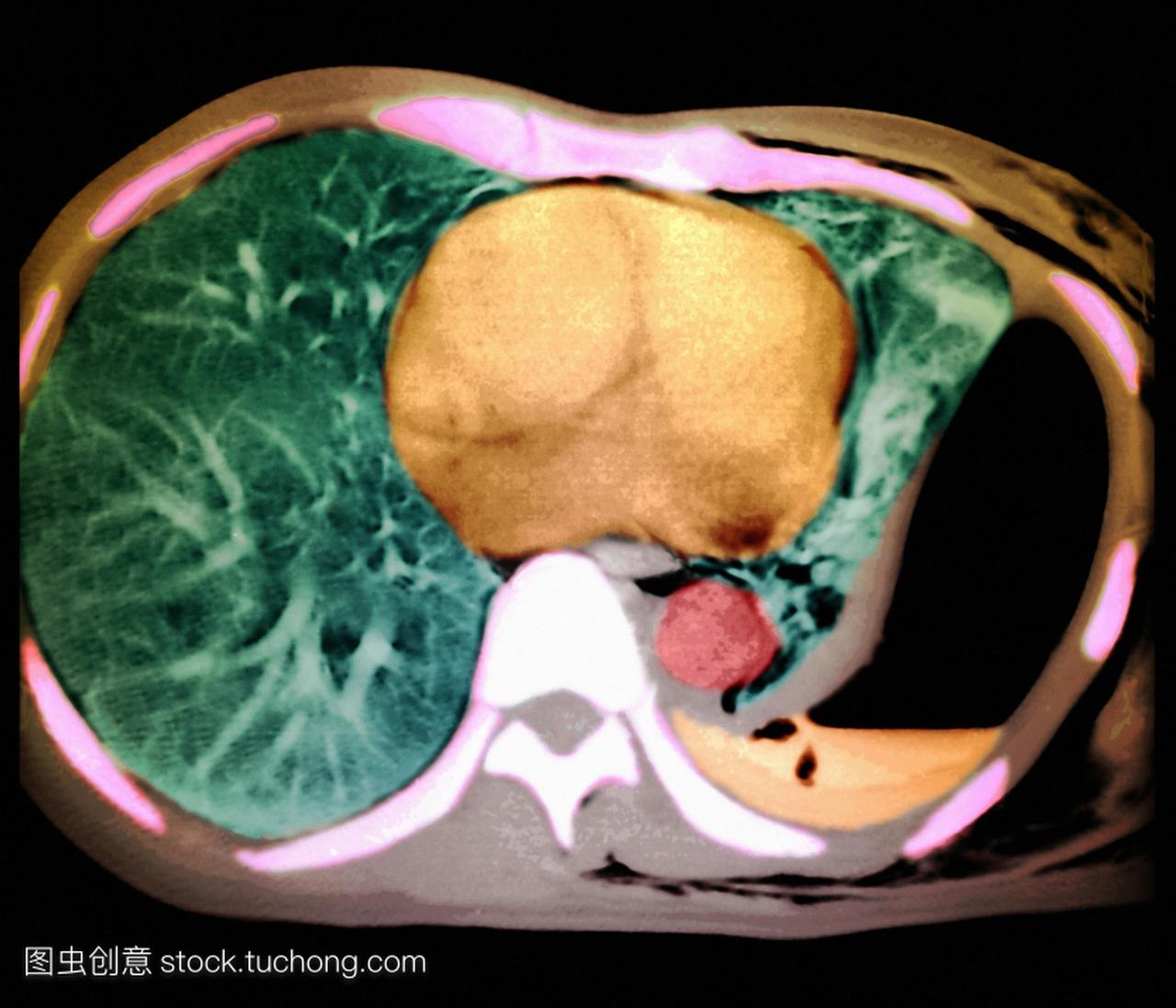 倒塌肺的计算机断层扫描ct扫描病人的胸部前面