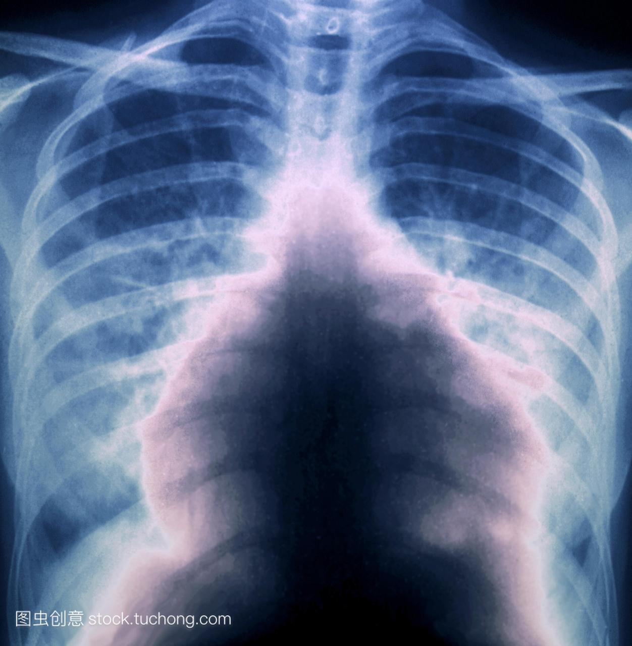 射线的大量肺栓塞患者的胸部。这发生在肺部动