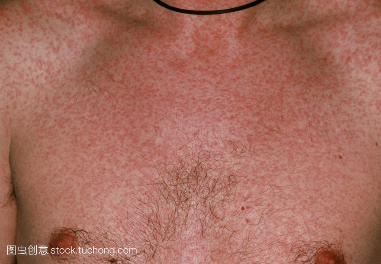 麻疹皮疹。一名患有麻疹的成年男性病人的胸部