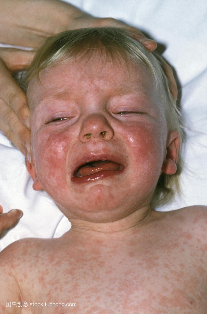 麻疹孩子脸上的皮疹和躯干。也称为麻疹或风疹