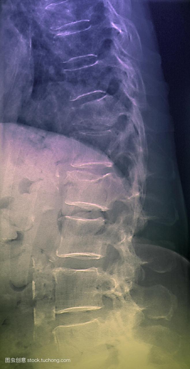 柱侧背侧的彩色x线片。骨质疏松症会使骨头失