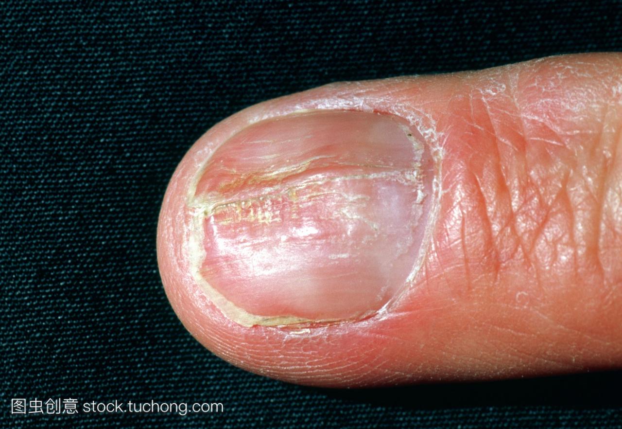 名69岁男子的手指,显示被牛皮癣损坏的指甲。