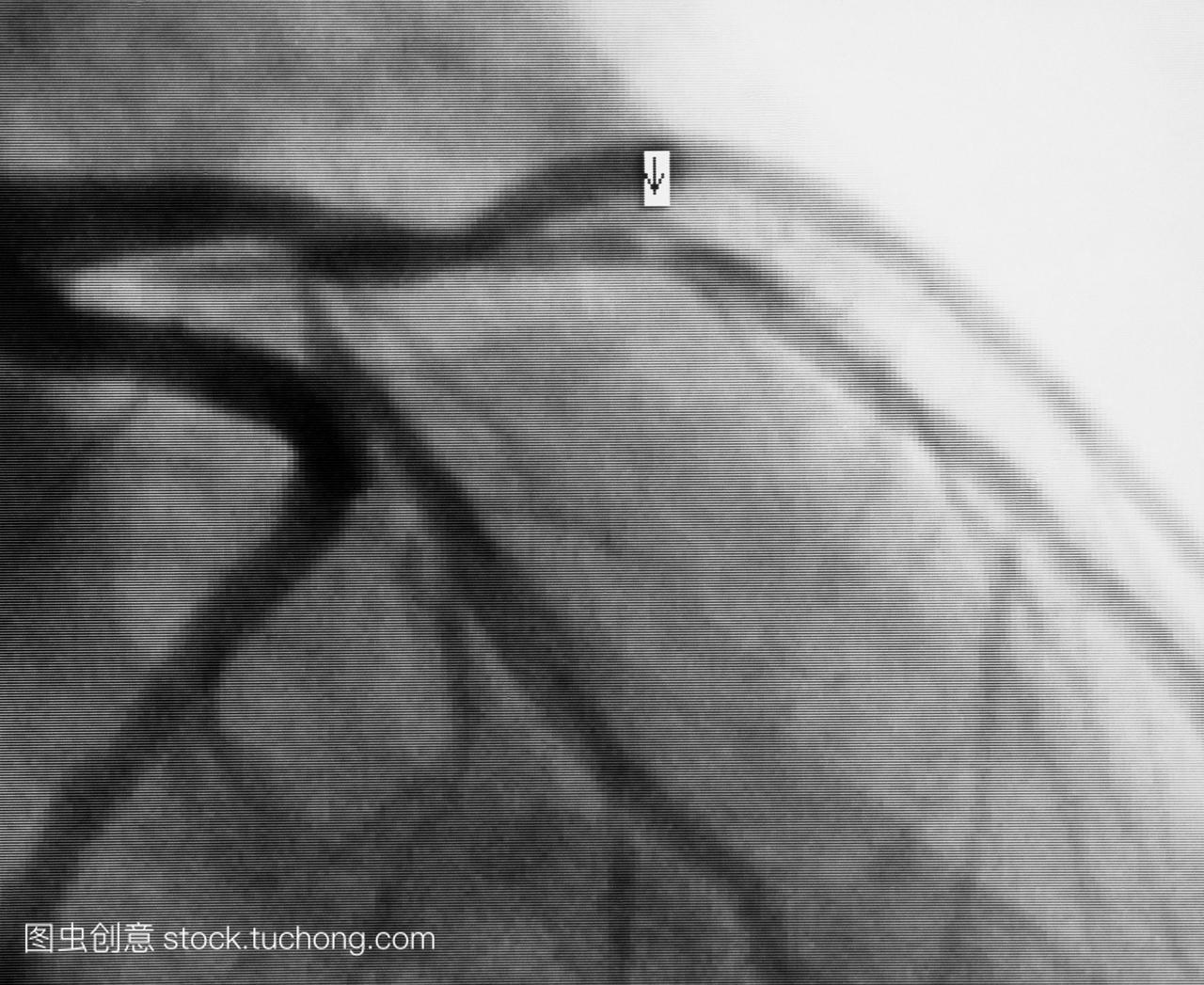 血管造影动脉波的成年人类心脏显示狭窄阻塞带