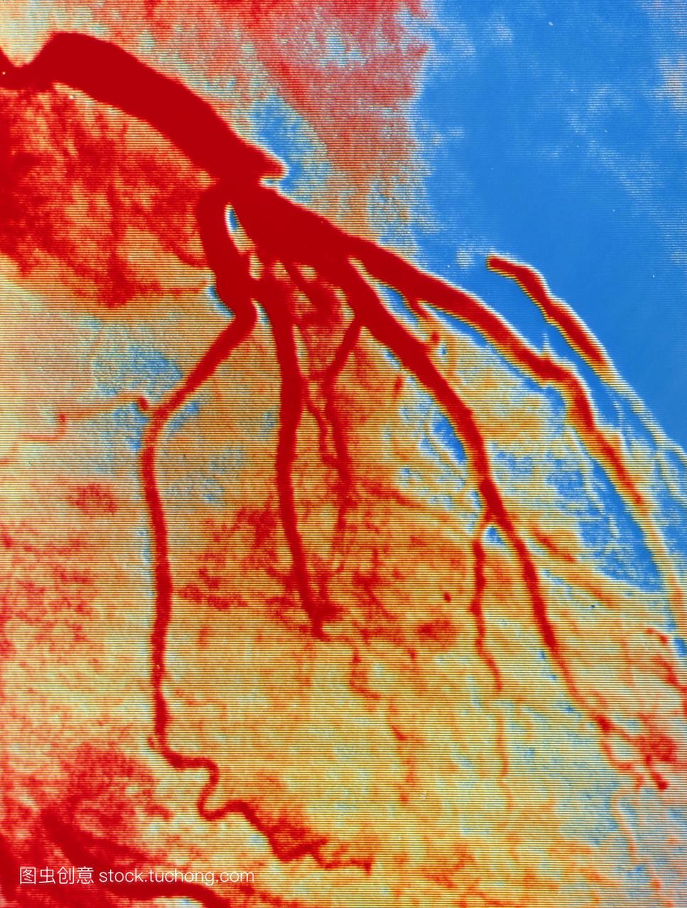 成人心脏的假彩色血管图动脉图显示在左前降l