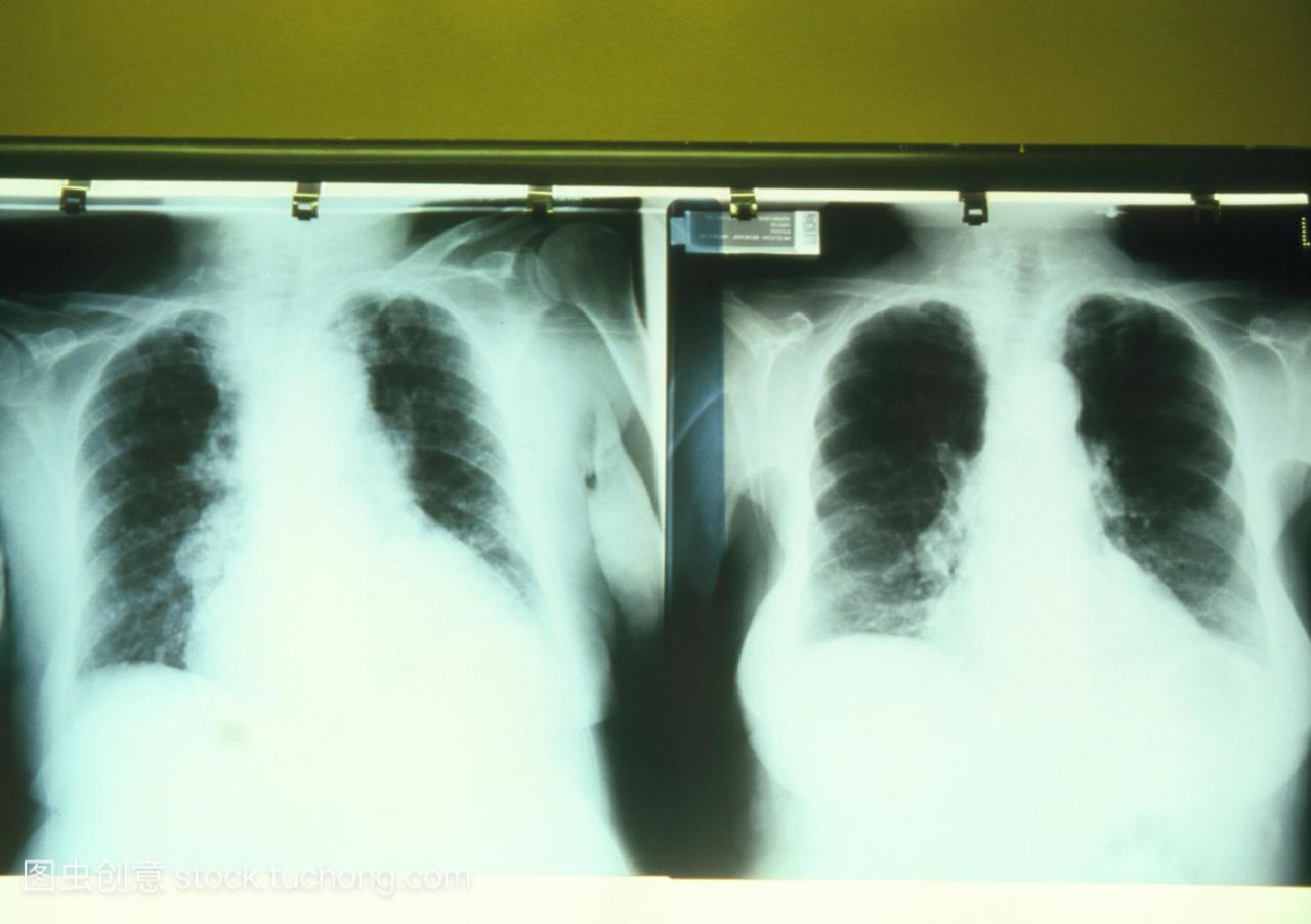 心力衰竭。病人的x光检查左和心脏衰竭右治疗