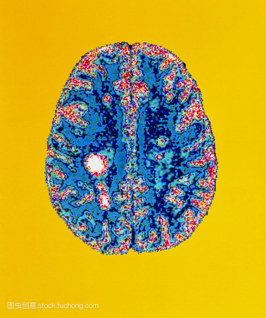 色物质在大脑深处被发现。由ms引起的病灶见