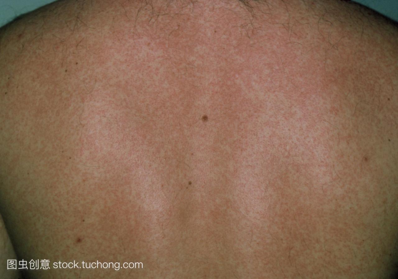 串的红点在一个人的背上风疹德国麻疹引起的。