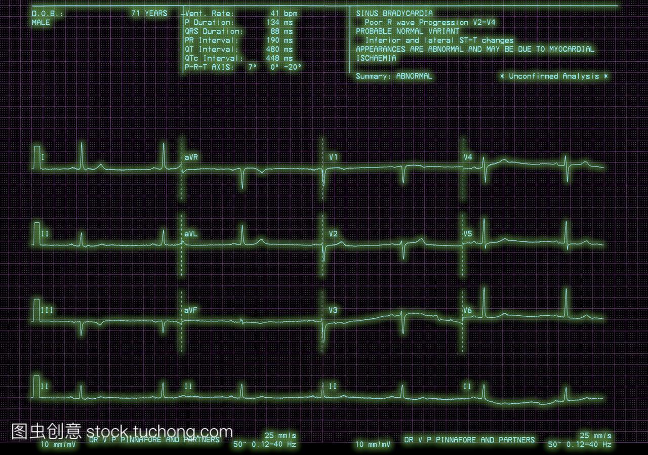 心脏病的心电图显示窦性心动过缓时心跳在一位