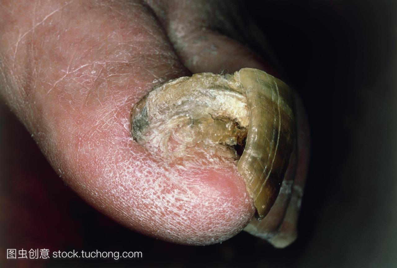 ogryphosis。的异常增厚变形大成人的脚趾甲。