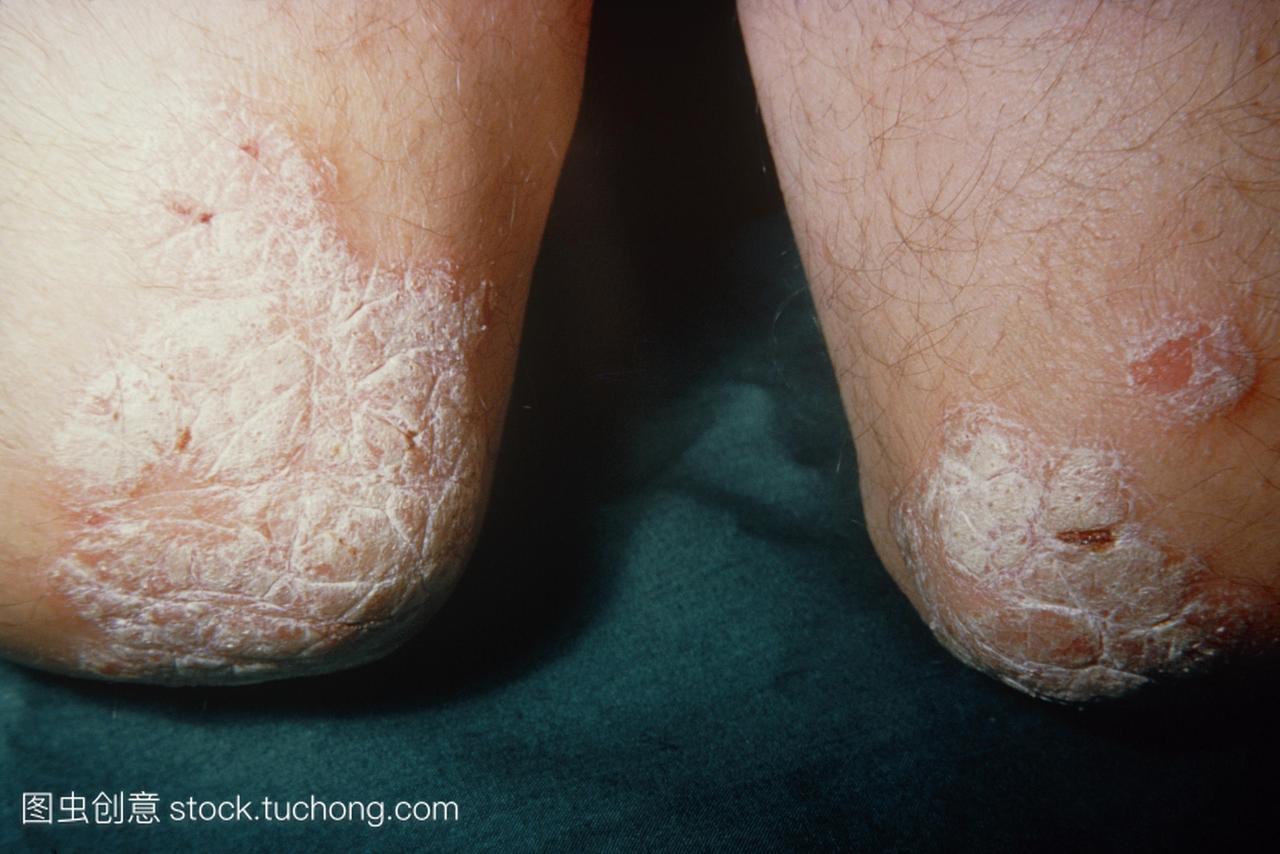 银屑病影响两肘。慢性皮肤疾病英国最常见的皮