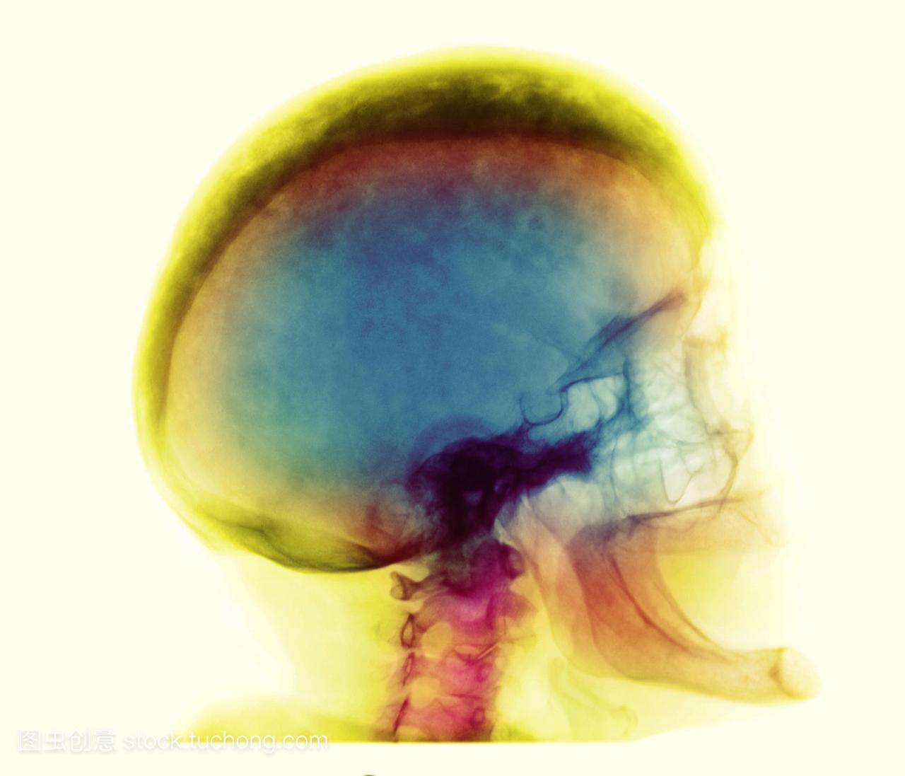 吉特氏病。彩色的x射线显示颅骨畸形性骨炎或