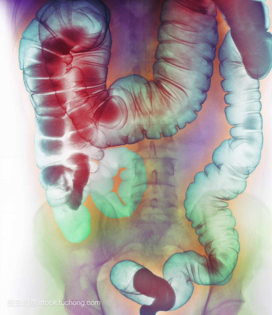 直肠炎。一名男性病人腹部的彩色钡灌肠x线,显