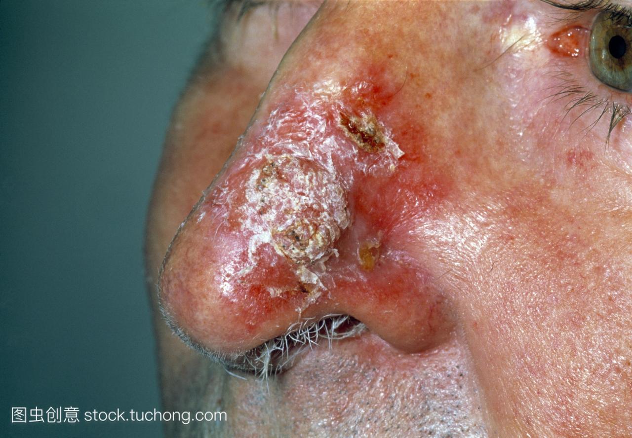 鼻皮疹。一名56岁男子的鼻子,其表现为盘状红