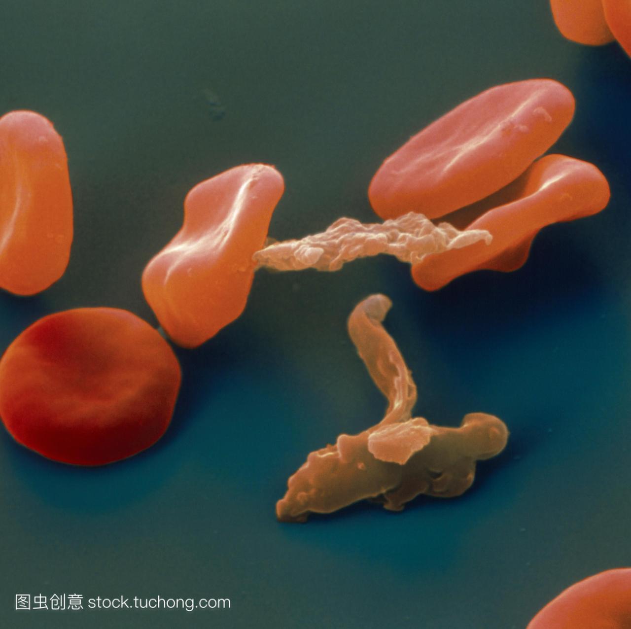 疾的原因。健康的红细胞是红色的受损的棕色。