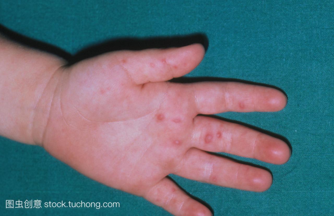 皮肤损伤在一个孩子的手由于一方面手足口病一