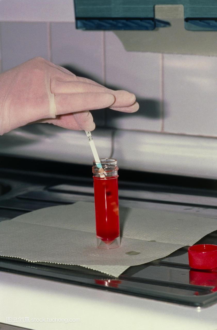 血尿尿测试尿液试纸测试urinanalysis进行确认
