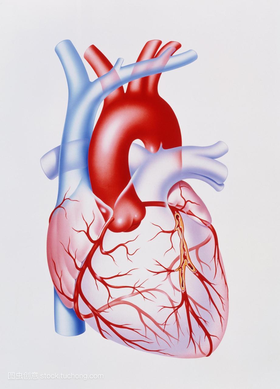 冠状动脉疾病。插图显示缩小人类心脏的冠状动