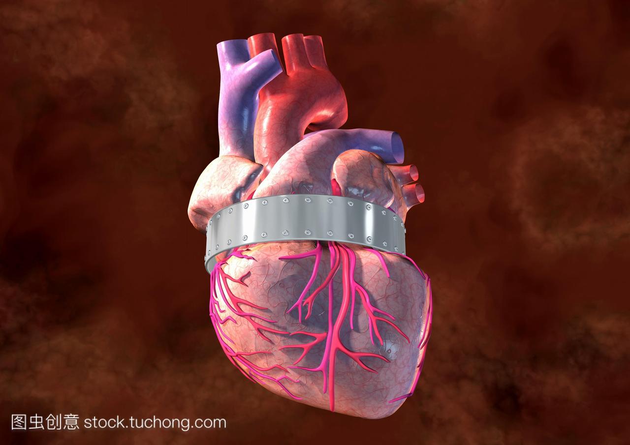 心绞痛概念电脑绘图。心脏被金属带挤压,它可