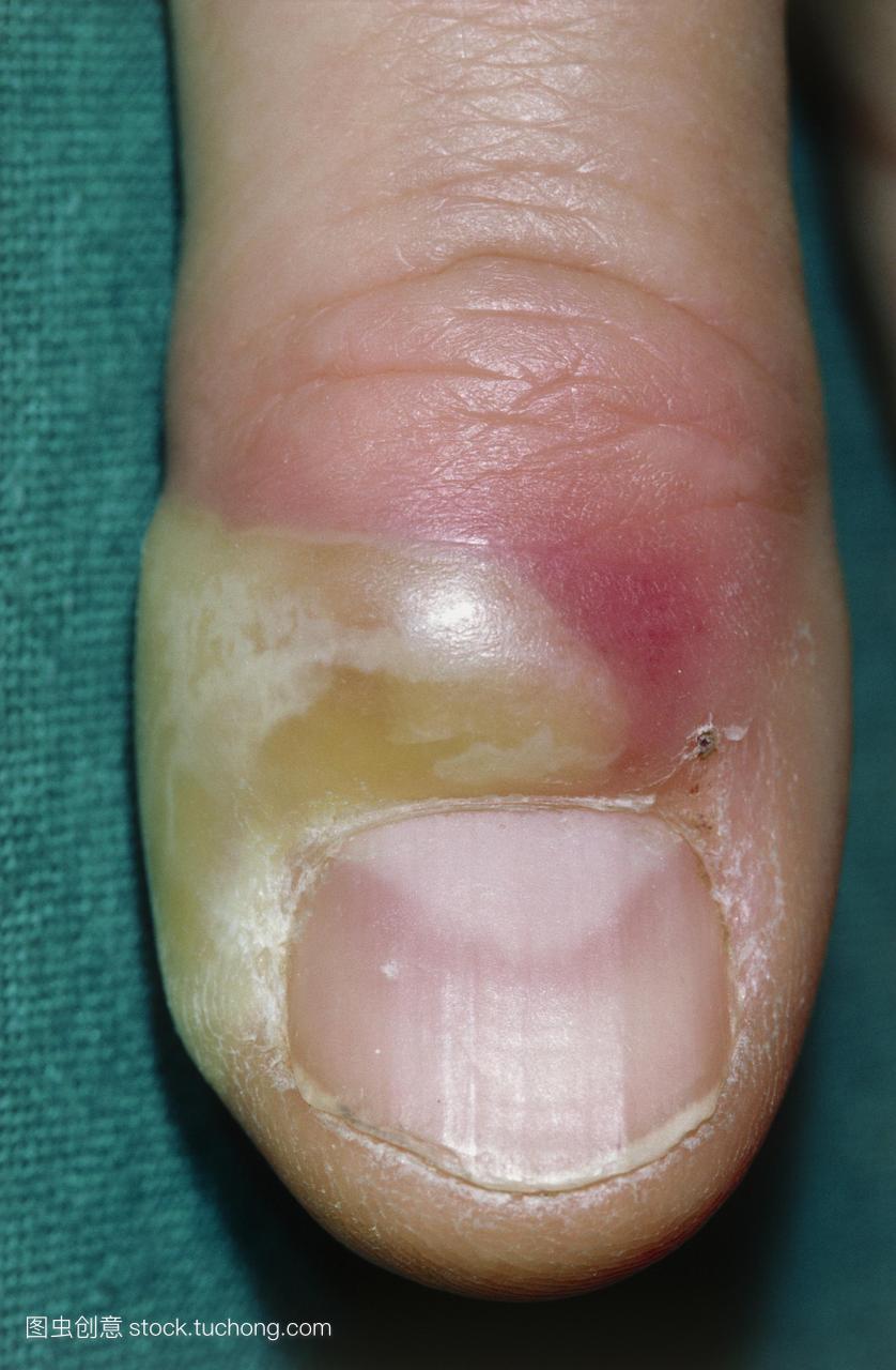 急性甲沟炎急性炎症和肿胀在指甲周围的组织。