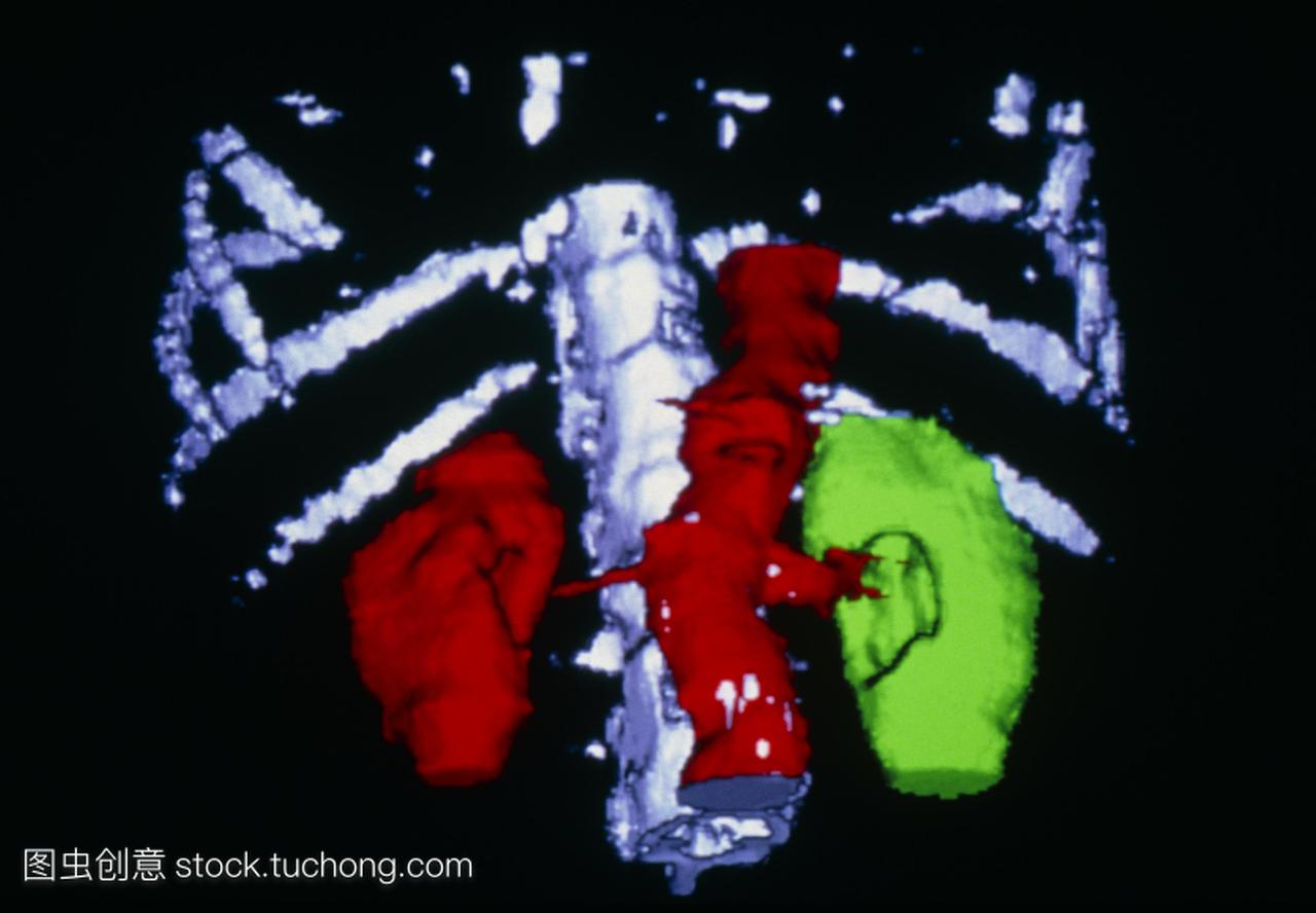 假彩色三维计算机断层扫描ct对肾动脉狭窄狭窄