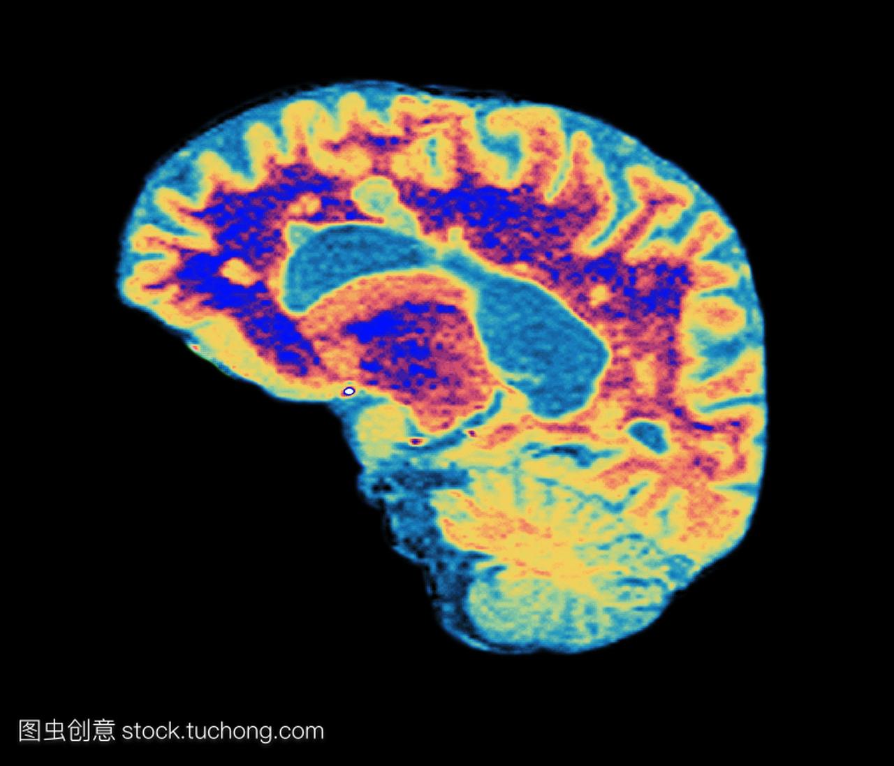 前部在左边。在ms的髓鞘周围,轴突神经纤维紫